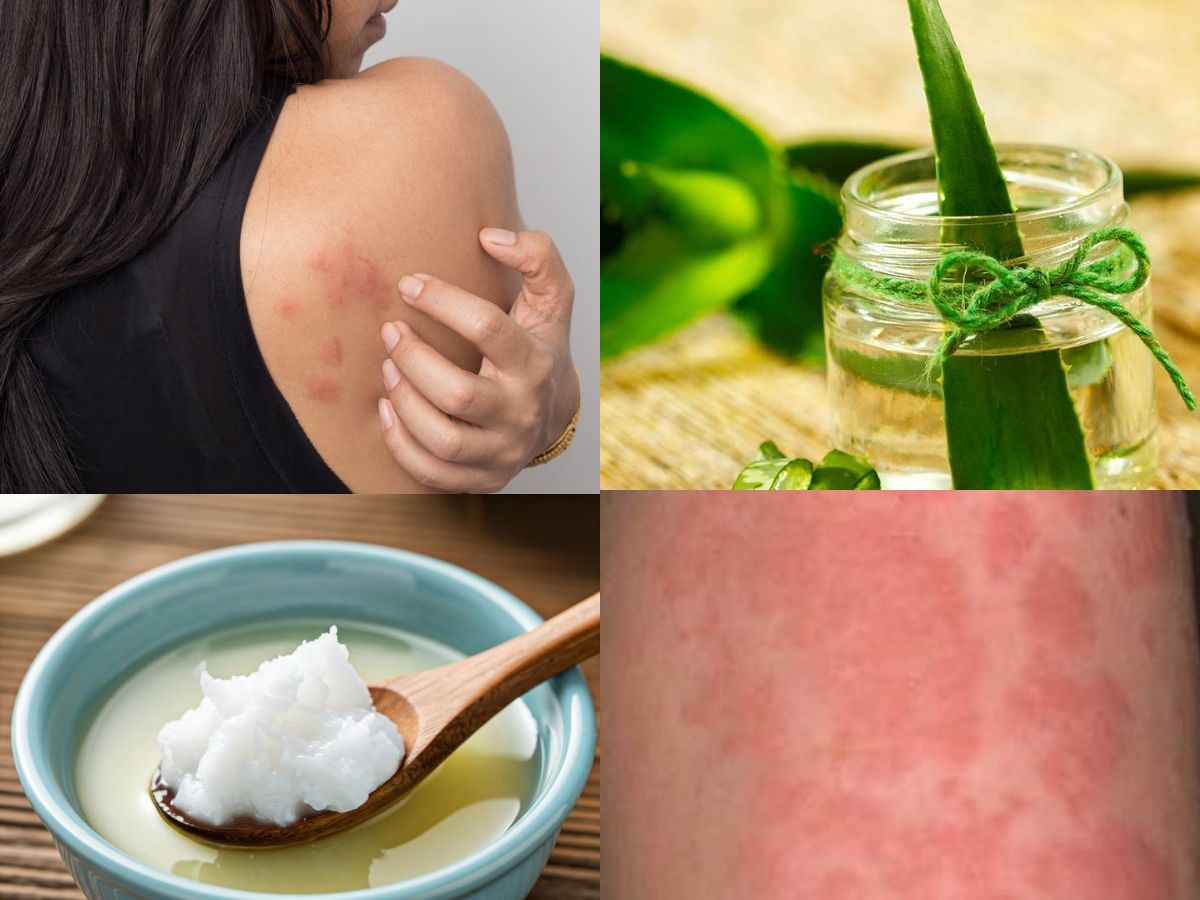 झुर्रियाँ, मुंहासों और ड्राई स्किन से पाए छुटकारा, रात भर Aloe Vera जेल लगाने से मिलेगी नेचुरल ग्लोइंग स्किन