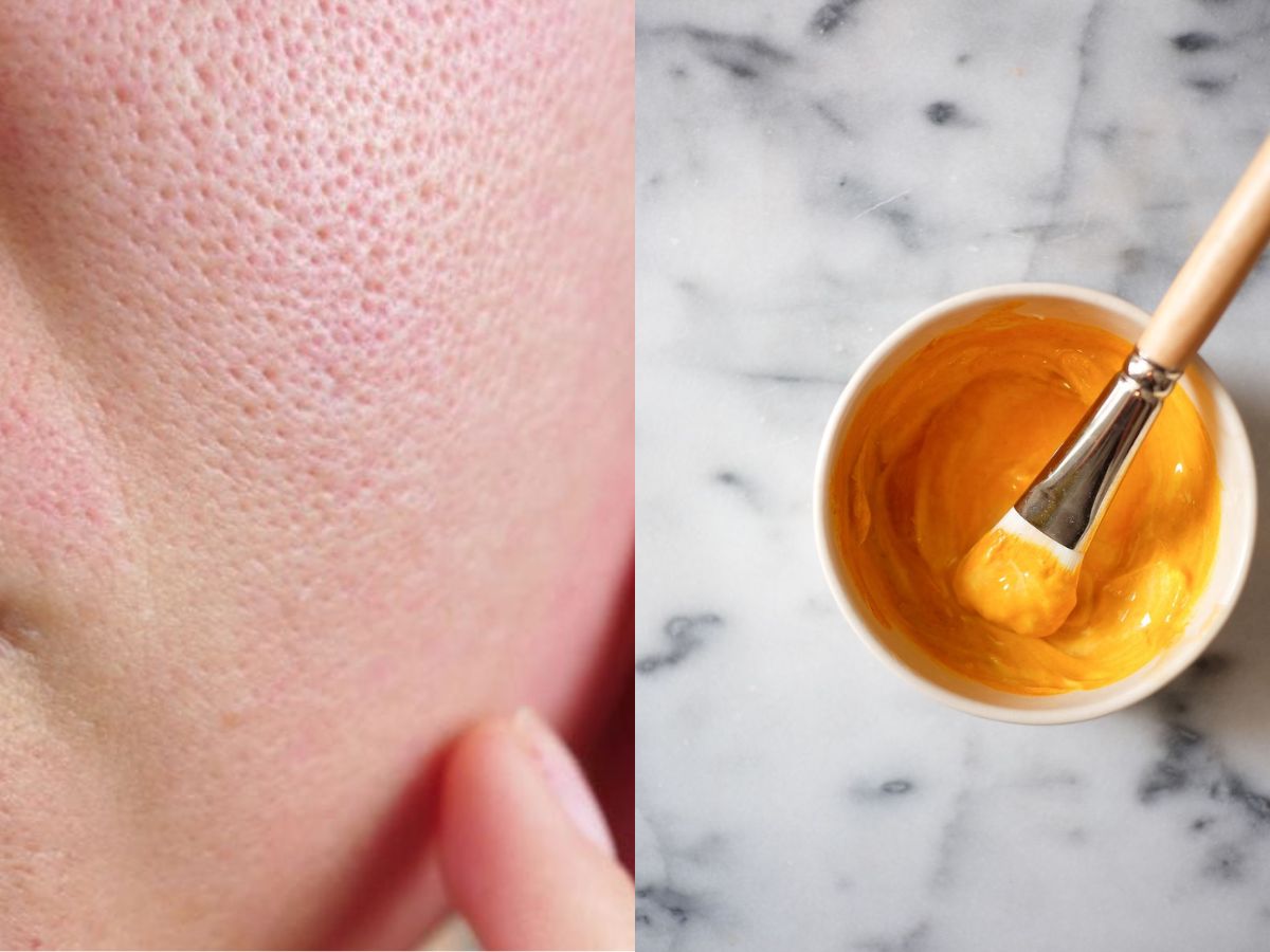 तिल और मस्सों से पाएं छुटकारा: इन आसान घरेलू नुस्खों से स्किन करेगी ग्लो और दमकता रहेगा चेहरा