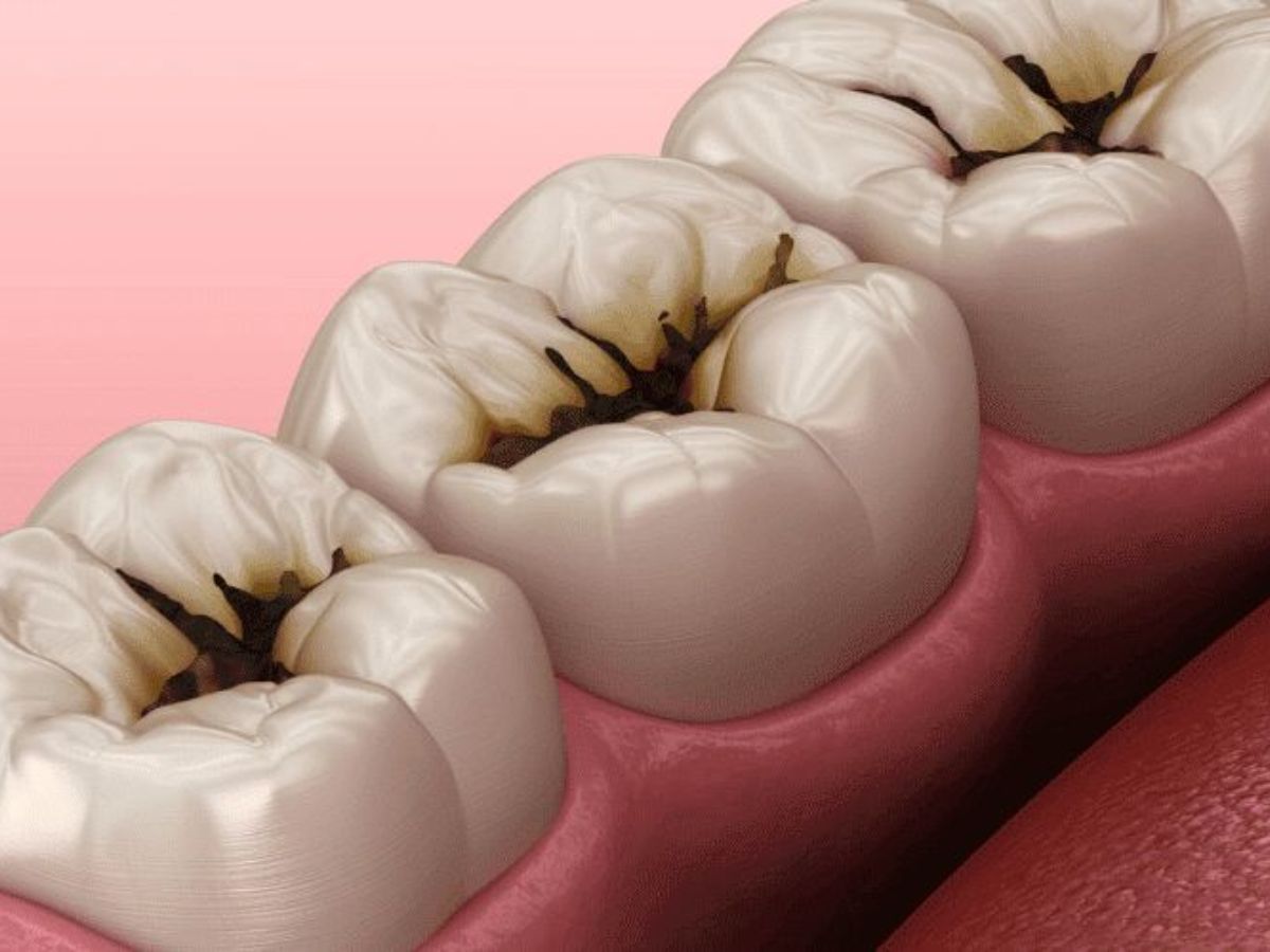 क्या आपको भी जानना है सफेद मुस्कान का सीक्रेट ? तो समाधान सिर्फ खानपान की ही नहीं बल्कि है विटामिन की ड़ोज भी