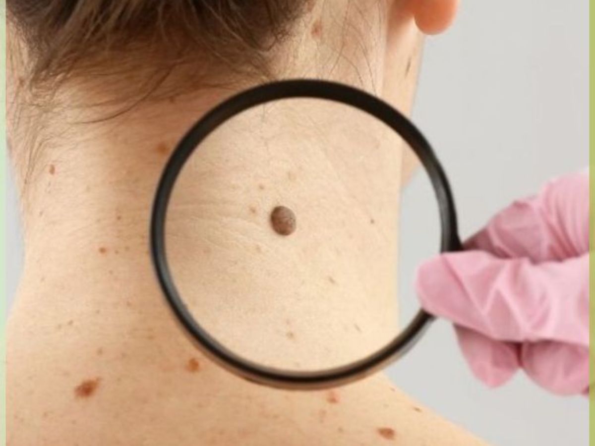तिल और मस्सों से पाएं छुटकारा: इन आसान घरेलू नुस्खों से स्किन करेगी ग्लो और दमकता रहेगा चेहरा - Photo Gallery
