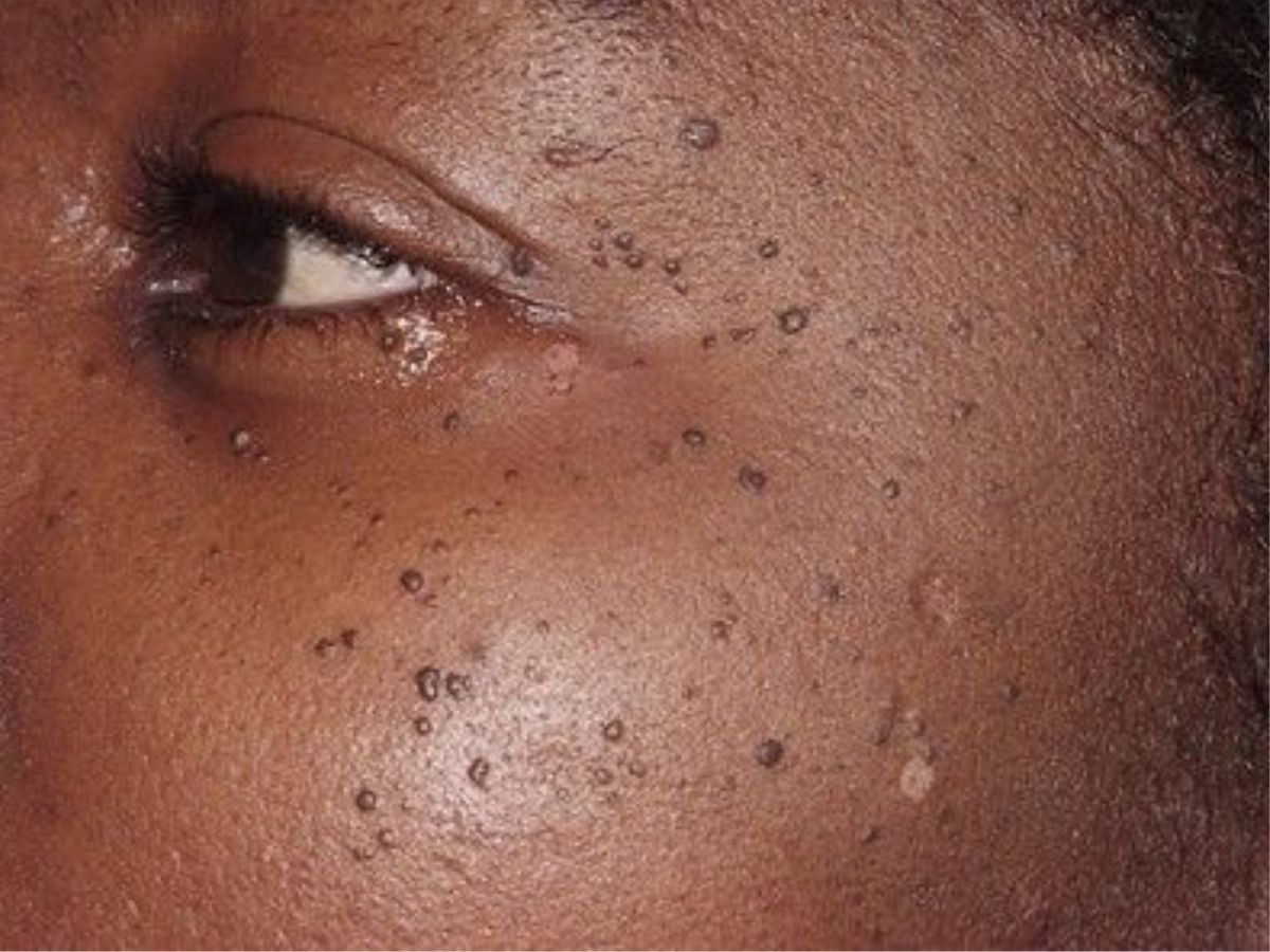 तिल और मस्सों से पाएं छुटकारा: इन आसान घरेलू नुस्खों से स्किन करेगी ग्लो और दमकता रहेगा चेहरा - Photo Gallery